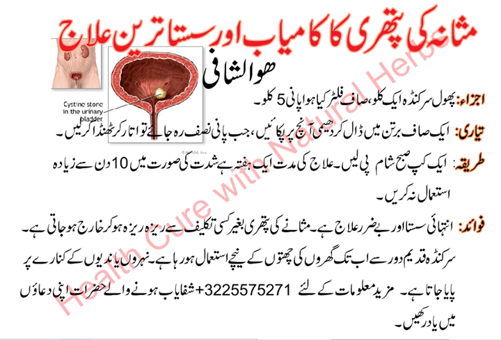 مثانہ کی پتھری کا علاج - Bladder Stone Herbal Treatment
