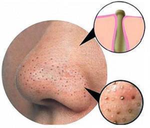Blackheads and Whiteheads: How to get rid of frackle