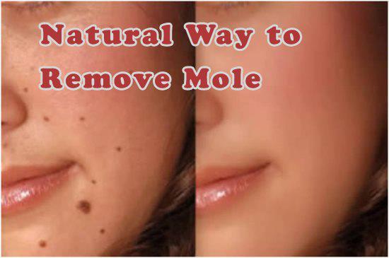 Remove Mole in 24 Days Naturally