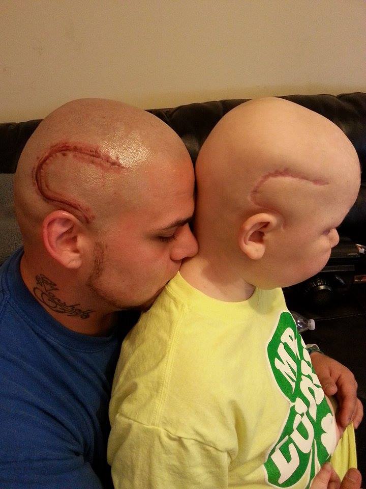 Father Tattoos cancer surgery scar of his son on his own Head