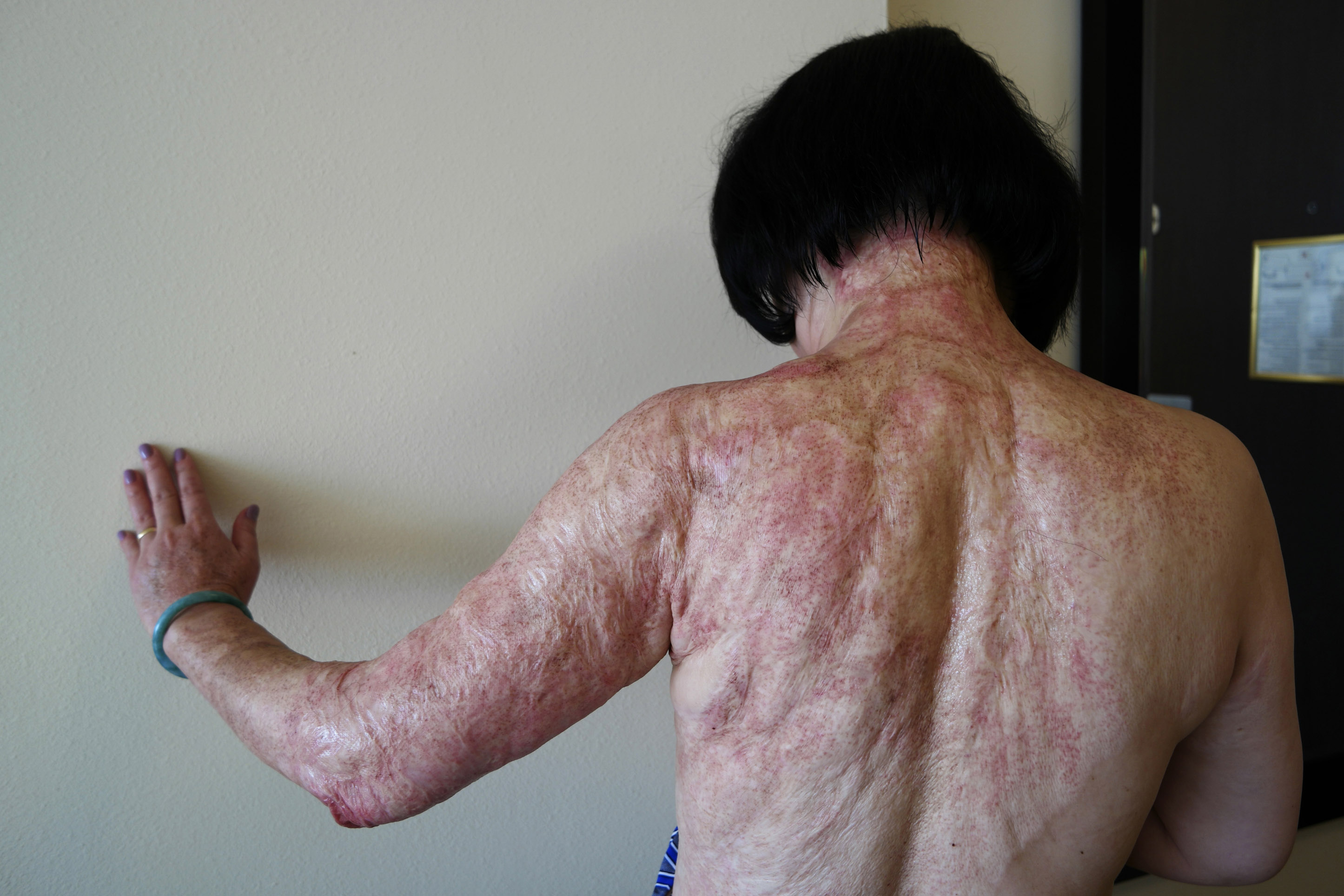 Napalm Girl of Vietnam War Iconic Photo after 44 years