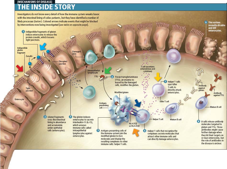 Gluten on Small Intestine Villi - Celiac Inside Story